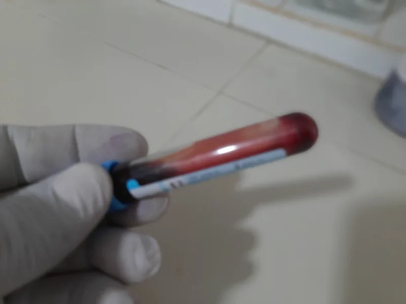 Blood in a citrate tube, the collection tube used for clotting tests